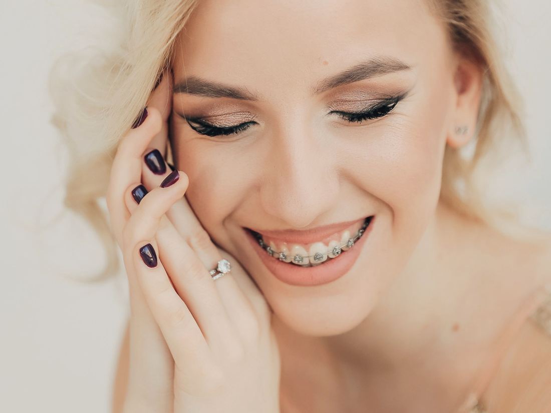 Mujer sonriendo con brackets metálicos