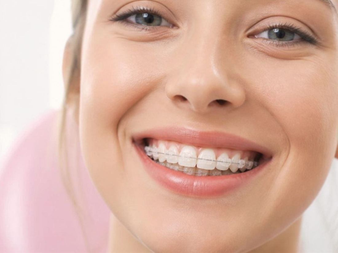 Sonrisa con brackets estéticos de zafiro transparentes