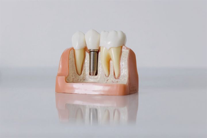 Modelo de un implante dental entre dos dientes